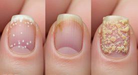 Các cấp độ nấm móng tay từ nhẹ, vừa đến nặng và dấu hiệu nhận biết rõ ràng.