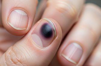 Ngón tay bị dập với móng bầm tím, thể hiện sự lo lắng về khả năng hồi phục móng.