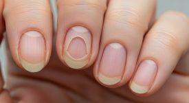 Hình ảnh cận cảnh móng tay bị lõm hình thìa, minh họa rõ nét tình trạng koilonychia.