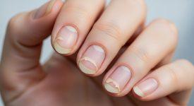 Hình ảnh móng tay bị tách lớp, giòn và dễ gãy, minh họa tình trạng móng yếu.