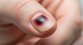 Hình ảnh cận cảnh móng tay bị tụ máu dưới móng do chấn thương, có vết bầm tím đen.