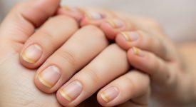 Móng tay bị vàng bất thường, dấu hiệu cần được quan tâm.