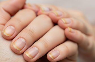 Móng tay bị vàng bất thường, dấu hiệu cần được quan tâm.
