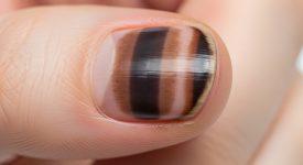 Móng tay có sọc đen với đặc điểm bất thường, gợi ý cần thăm khám bác sĩ