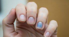 Móng tay màu tím nhạt là dấu hiệu của tình trạng thiếu oxy trong máu.