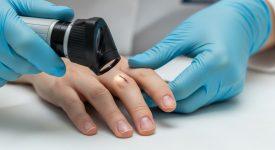 Bàn tay của bác sĩ đang cầm kính soi da kiểm tra móng tay của bệnh nhân, minh họa việc phát hiện ung thư móng tay sớm