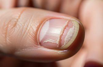 Hình ảnh cận cảnh móng tay bị xước và da khô xung quanh, tượng trưng cho dấu hiệu cảnh báo sức khỏe.