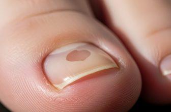 Móng chân bị lõm (Koilonychia) rõ rệt, hình thìa