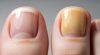 So sánh móng chân khỏe mạnh và móng chân bị vàng do nhiều nguyên nhân